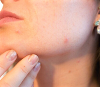 Acne doesn't go away, but the good news is it is treatable.
